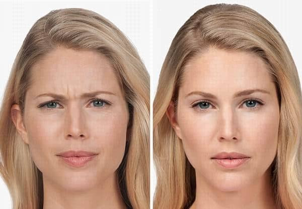 بوتاکس پیشانی چیست؟ 0 تا 100 همه چیز در مورد تزریق بوتاکس پیشانی