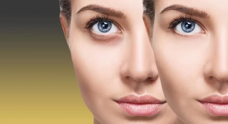 کربوکسی تراپی زیر چشم چگونه است؟ بررسی کامل کربوکسی تراپی چشم