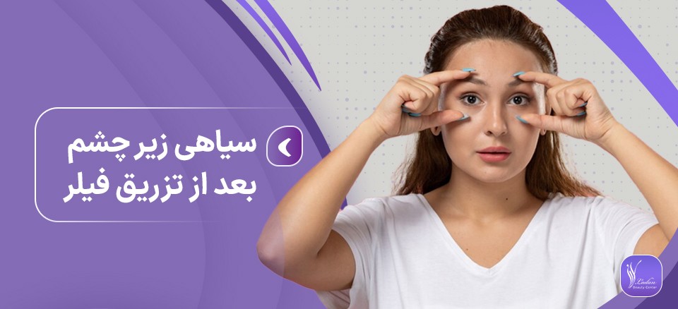 سیاهی زیر چشم بعد از تزریق فیلر + راه حل - مرکز زیبایی لادن