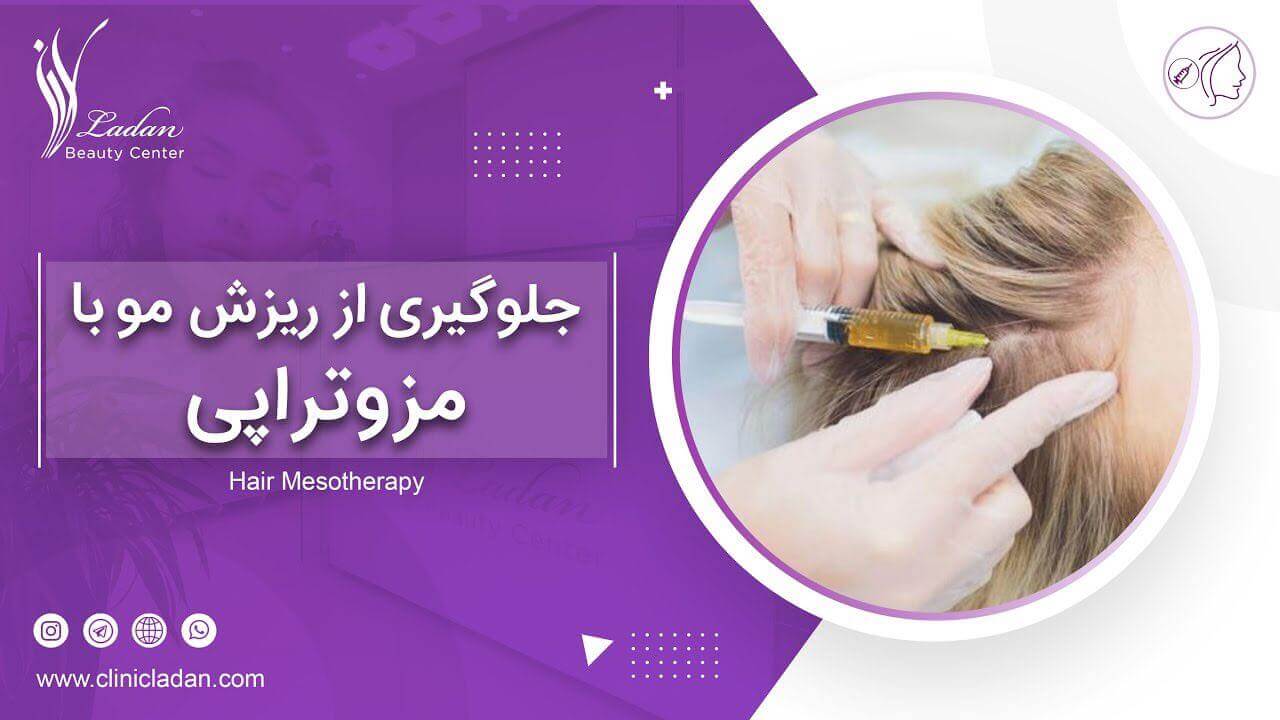 مزوتراپی مو