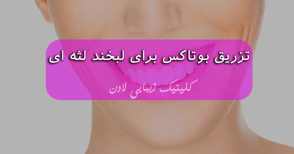 تزریق بوتاکس برای لبخند لثه ای - تزریق بوتاکس لثه - مرکز زیبایی لادن