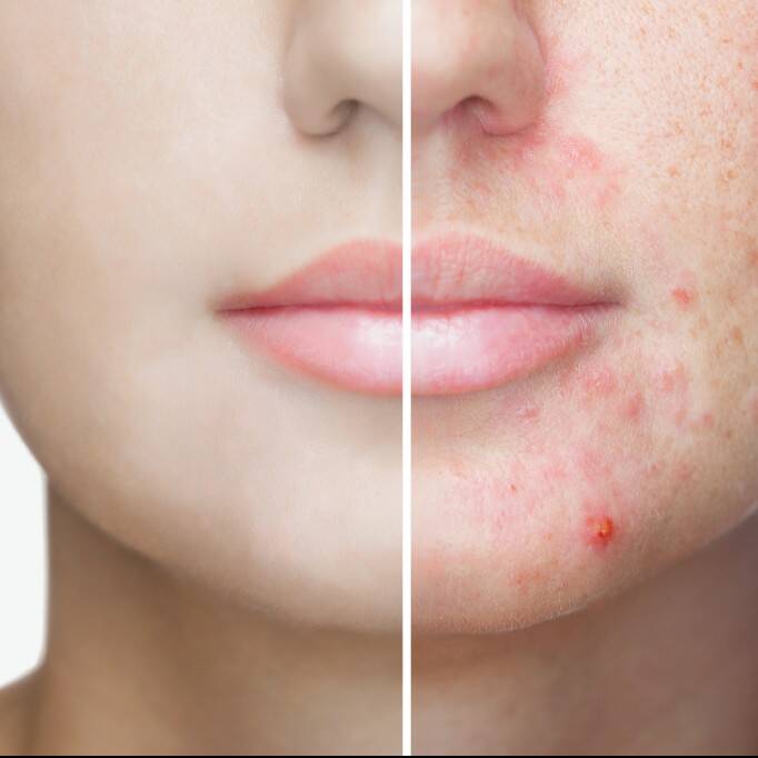 فیشیال برای درمان جوش، مزایا و معایب آن