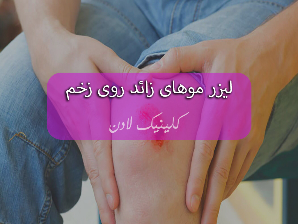 لیزر موهای زائد روی زخم چه عوارضی دارد؟ هزینه آن چقدر است؟