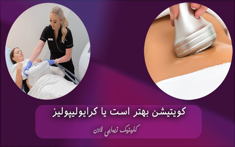 کویتیشن بهتر است یا کرایولیپولیز؟