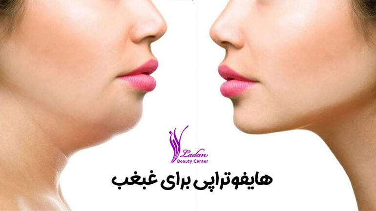 هایفوتراپی غبغب چیست؟ مزایا و عوارض