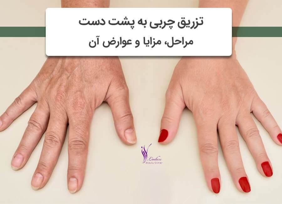 تزریق چربی پشت دست چگونه انجام میشود؟عوارض و مزایا تزریق چربی