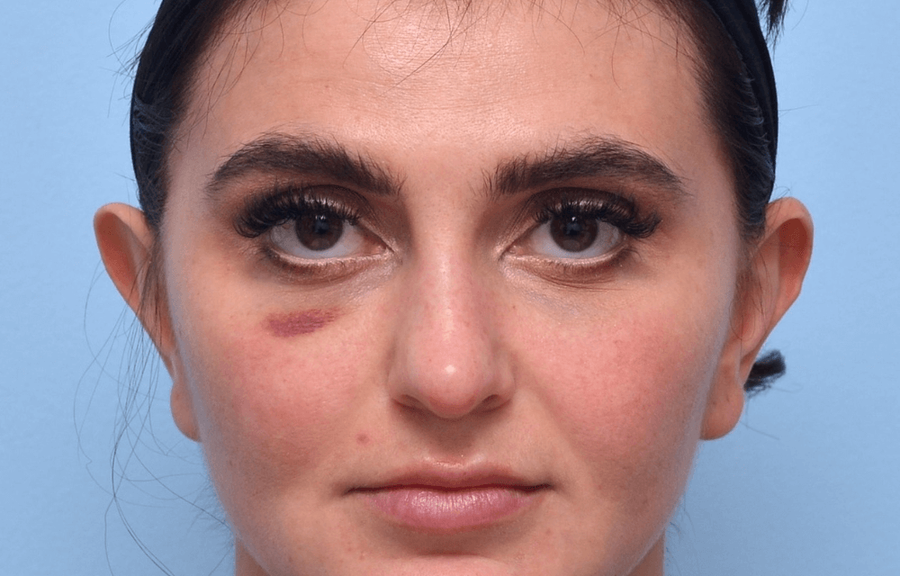 سیاهی زیر چشم بعد از فیلر